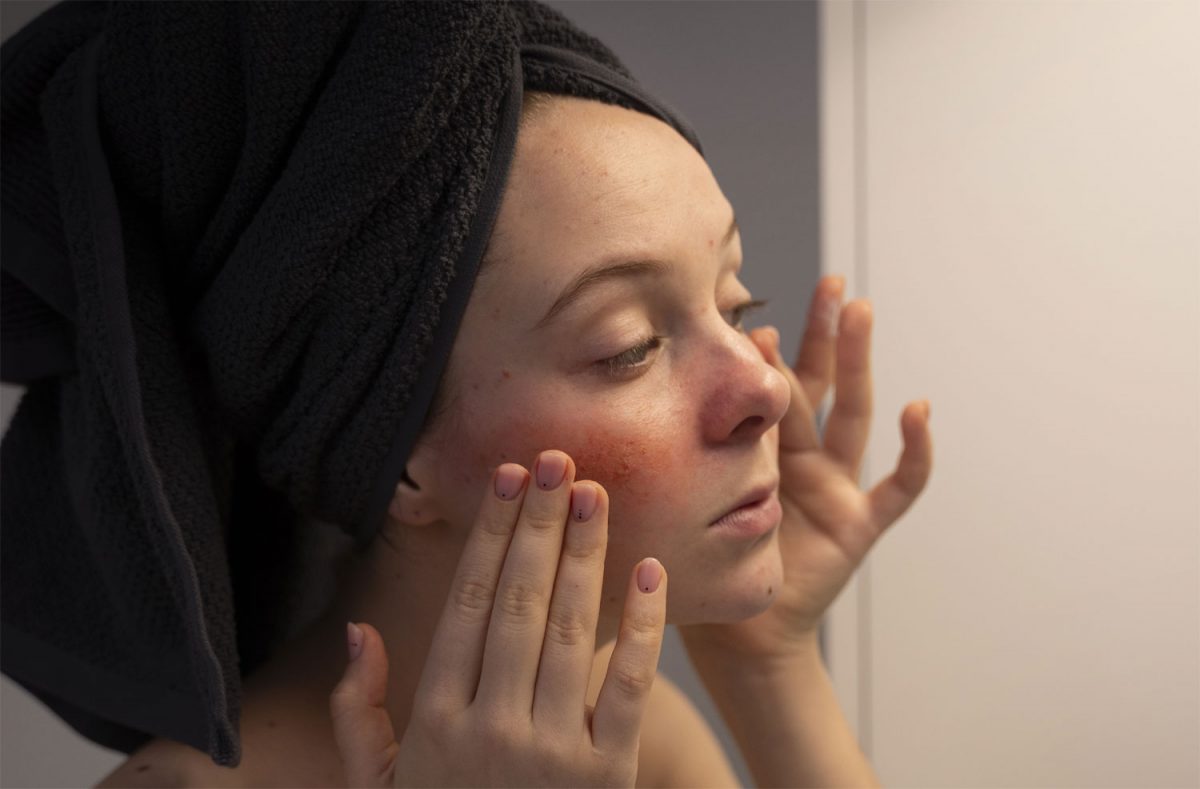 rosacea-1-1200x789.jpg